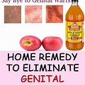 Genital Warts Home Remedy