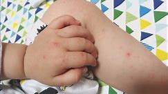 急性ウイルス性感染症の「手足口病」が流行　県が2年8か月ぶりに “警報” 発表　大分 | OBSニュース