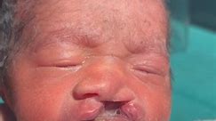 Cleft lip and cleft palate Congenital anomalies #newbornbaby | Medical practice