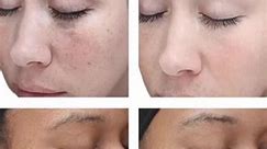Click each picture for results of different peels that VI Peel offers! | Unfiltered Aesthetics KY