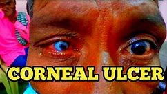 CORNEAL ULCER//Keratitis//Ophthalmology & Optometry//At tamil