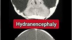 Hydranencephaly - Radiology