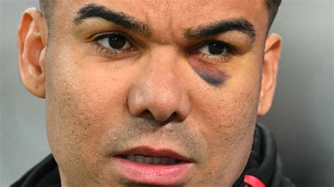 How Casemiro suffered black eye after shocking fans with shiner in Man ...