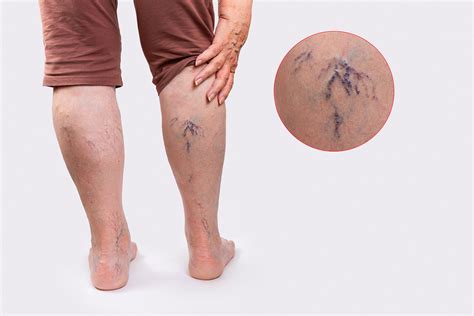 Restless Legs Syndrome Causes and Treatments - Cura Vein Doctors