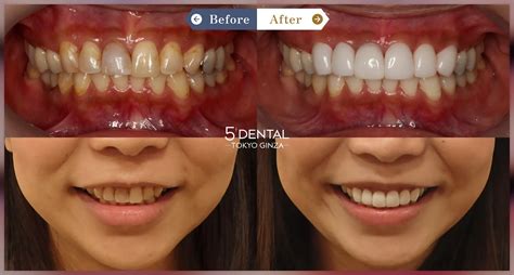 前歯の詰め物の変色 | 東京の審美歯科・セラミックなら 5DENTAL東京銀座