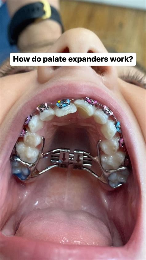 Palatal Expanders For Recessed Maxilla