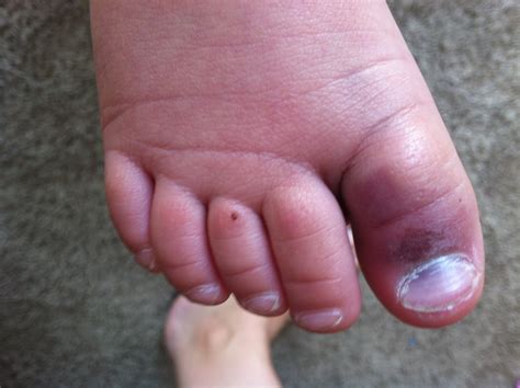 Identify Signs of a Broken Toe for Immediate Relief ⋆ ctf.bnsf.com