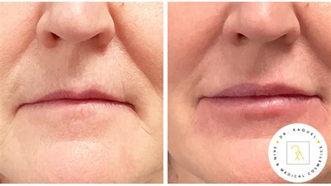 Guide to Lip Filler Recovery - 5 Steps