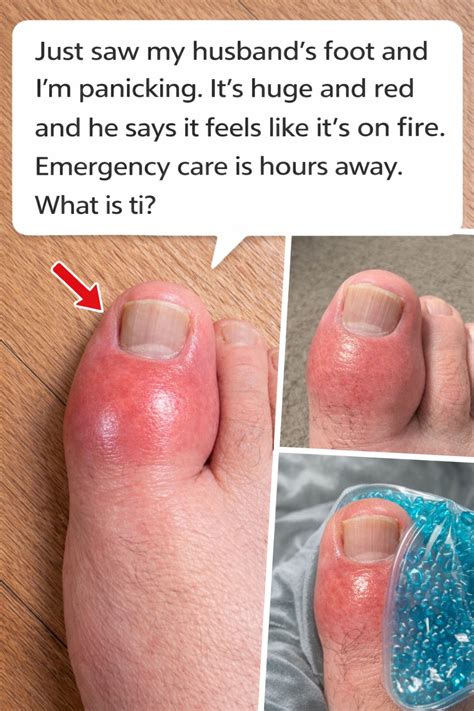 What Does It Mean If Your Foot Suddenly Becomes Red, Swollen, and Feels ...