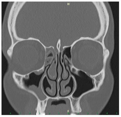 Role of the Lund–Mackay Score in Determining Surgical Indication in Odontogenic Chronic ...