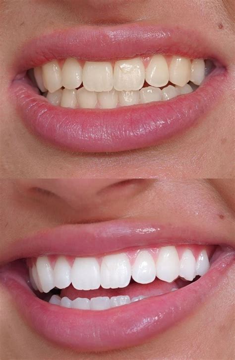 Discover powerful natural remedies to stop and reverse receding gums ...