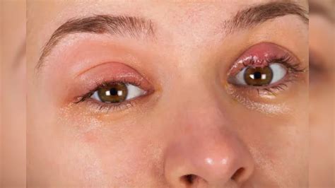 Ever noticed a small lump on your eyelid? Know all about chalazion and ...