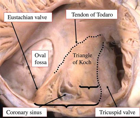 Triangle of koch in heart...(imp landmark of AV node) | Medical anatomy ...