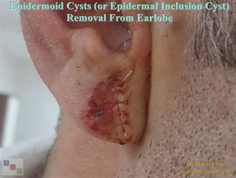 Removal of Earlobe Cyst