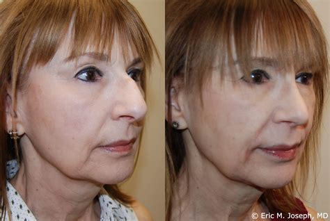 Eric M. Joseph, MD | Rhinoplasty Before & After: Hanging Columella and ...