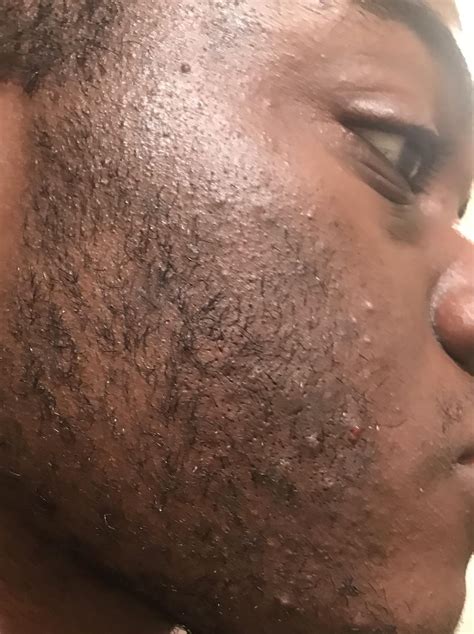 [Hair Removal] Ingrown hairs on cheek, any tips on how to treat them ...