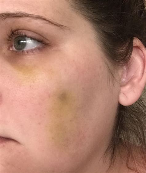 Dark bump under skin after being punched in the face by my brother because he stole my ...