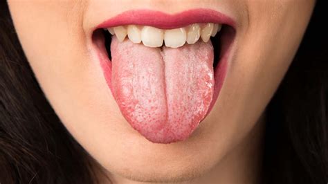What Deficiency Causes White Tongue? – NutritionFact.in