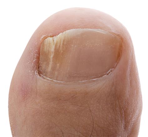 White Patches On Toenails - Causes, Signs & 5 Best Treatment