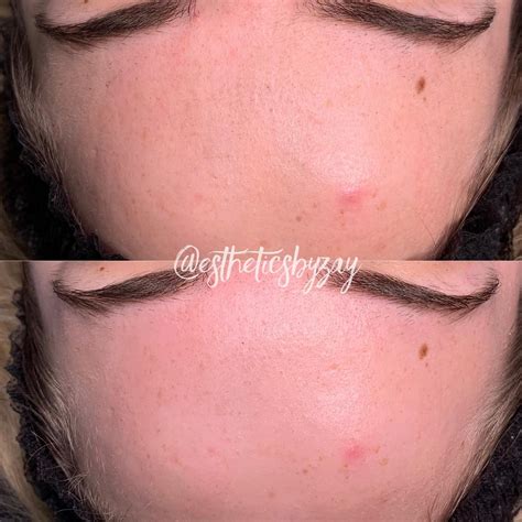Before/after Microdermabrasion facial 😍 Microdermabrasion is my top ...