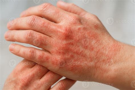 A close-up of irritated, red skin on hands, indicating eczema or dermatitis symptoms with dry ...