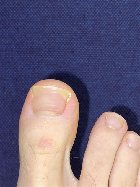 Please someone help me. The corner of my toenails have been yellow for quite some time and has ...