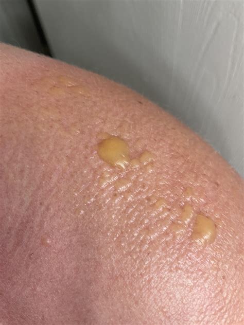 Second degree sunburn should I go to the ER? : r/DermatologyQuestions