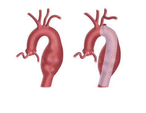 Thoracic Aortic Aneurysm