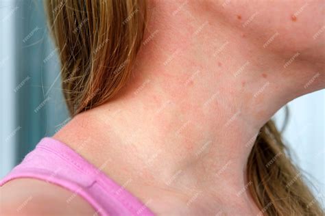 Premium Photo | Allergic dermatitis on skin of woman's neck skin disease neurodermatitis disease ...