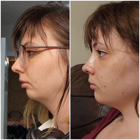 19 days post op djs, swelling still killer : r/jawsurgery