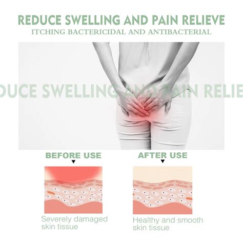 South Moon Plant Herbal Hemorrhoid Ointment Pain Soothing Anal Bleeding ...