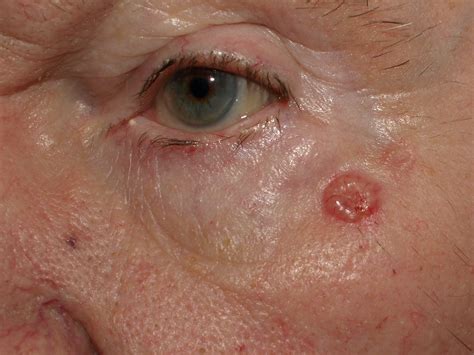 Basal Cell Carcinoma Stages Pictures at Gayla Wilson blog