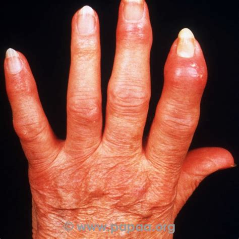 Psoriatic Arthritis Hands