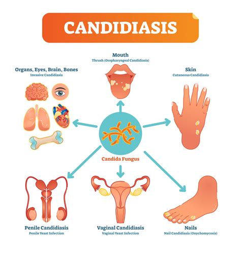 Candidiasis: causas, síntomas y consejos - Blog de Naturlíder : Blog de Naturlíder