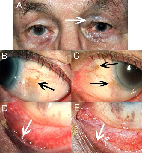 Primary Acquired Melanosis Atypia
