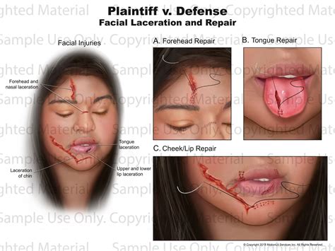 Facial Lacerations 1 - MotionLit