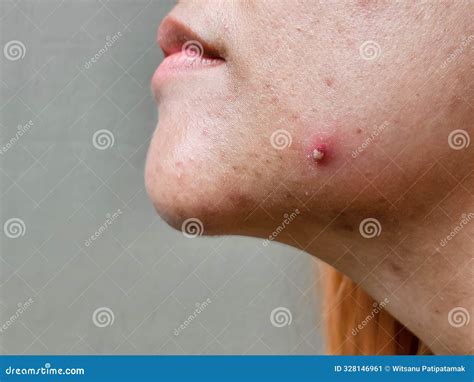 Pustular Acne with Pus on the Face and Cheeks of an Asian Woman Stock Image - Image of ...