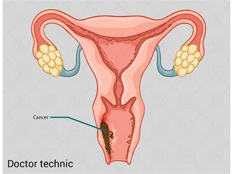 Vaginal Cancer: Causes, Symptoms, Diagnosis, and Treatment Options