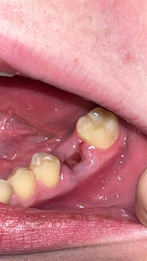 molar tooth extraction 7 days ago. is it healing properly? : r/askdentists