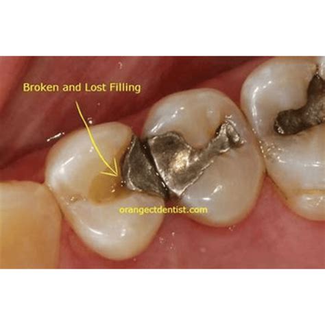 What to Do If Your Tooth Filling Fell Out? - Smile Studio Boston