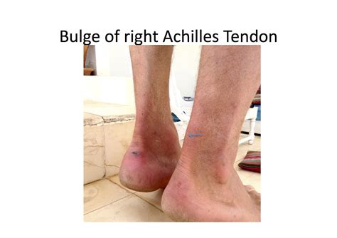 Achilles Tendinopathy | Private GP and Wellness Clinic Belfast