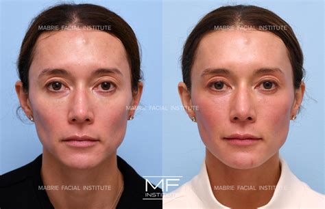 Sunken Temples Before and After Pictures Case 1342 | San Francisco, CA ...