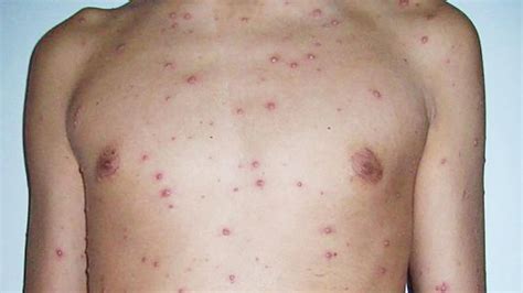 Los primeros síntomas de la varicela en niños: cómo detectarlo y qué hacer