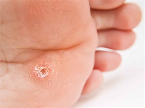 Warts vs Skin Cancer: How to Tell the Difference
