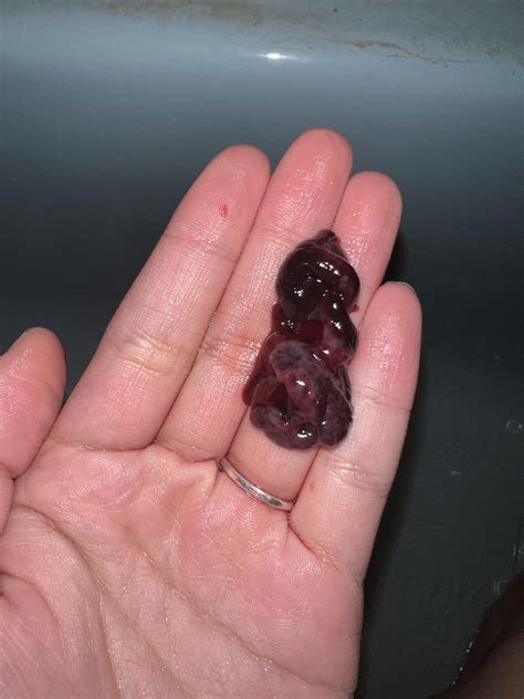 How Do Blood Clots Form Period at Oliver Wolff blog