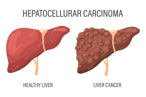 Carcinoma hepatocelular enfermedades del hígado hígado sano y cáncer de ...