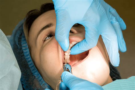 How Long After Wisdom Teeth Removal Can I Eat?