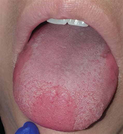 Benign migratory glossitis | Cleveland Clinic Journal of Medicine