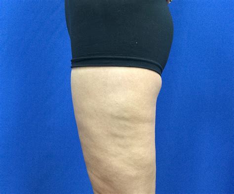 Beverly Hills patient gets smaller thighs with thigh lift surgery.