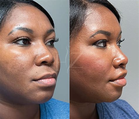 Upper lip lift Before & After (HZ Plastic Surgery) | Upper lip, Lips, Plastic surgery